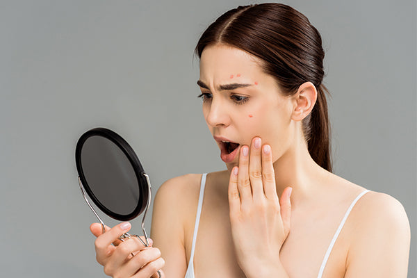 Does Increased Estrogen Cause Acne?