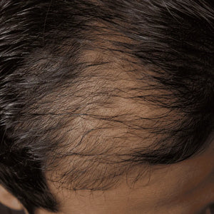 Hair Growth