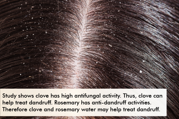 clove + rosemary water can help treat and manage dandruff