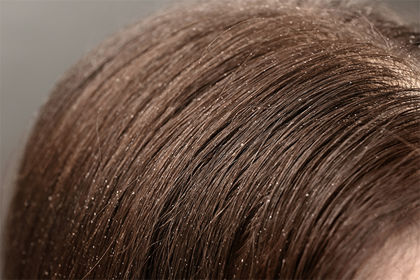 can hair spa remove dandruff?